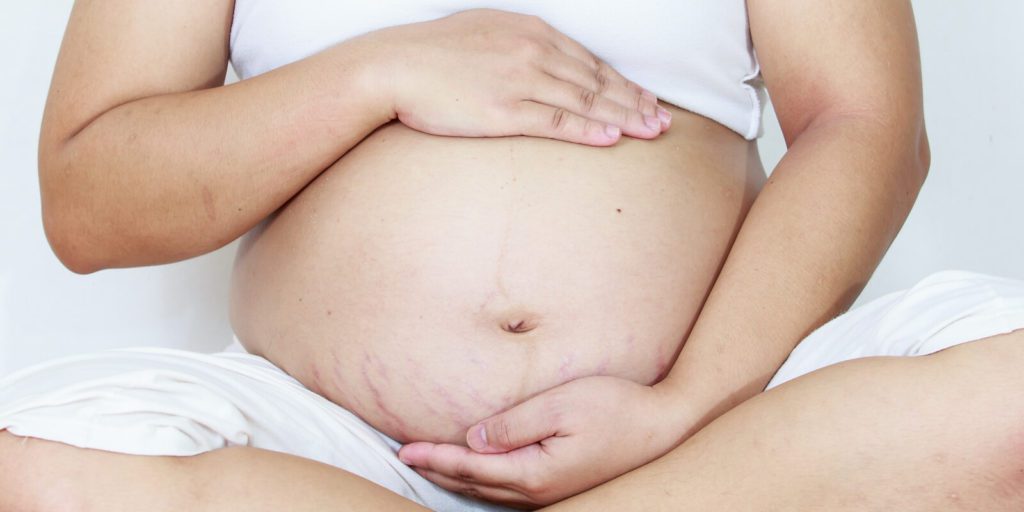 How to Get Rid of Pregnancy Stretch Marks with Simple Steps & Safe Products